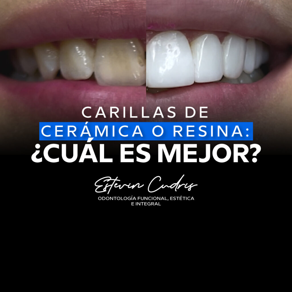 Carillas dentales en Bucaramanga