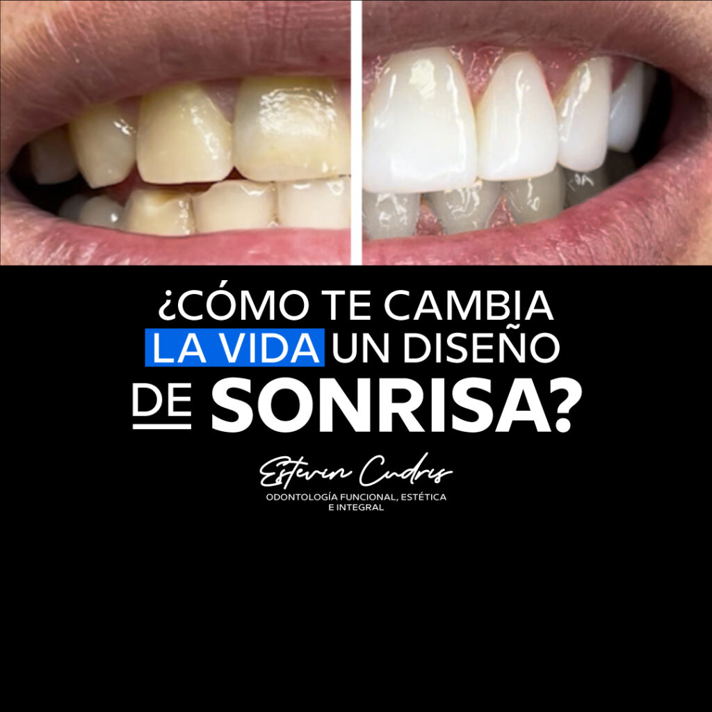 Diseño de sonrisa Bucaramanga