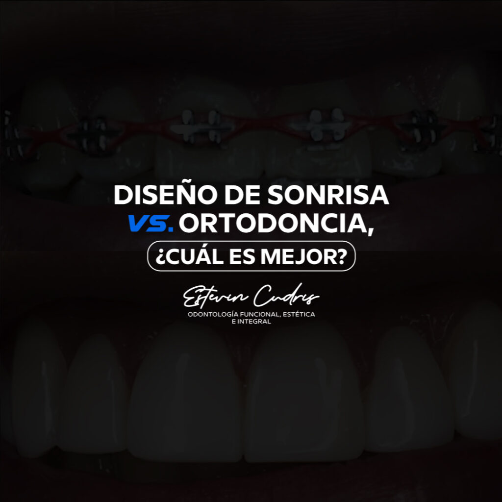 diseño de sonrisa vs ortodoncia