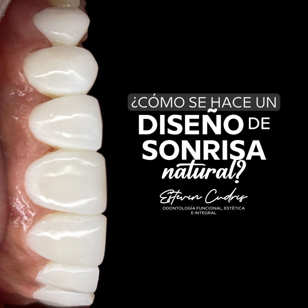 Diseño de sonrisa