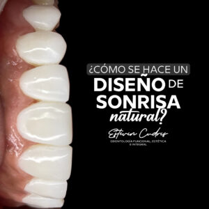 Diseño de sonrisa